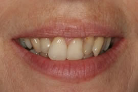 CEREC AC OMNICAM ПРОСТОЕ СКАНИРОВАНИЕ БЕЗ АНТИБЛИКОВОГО СПРЕЯ 24.jpg