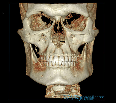 Ray α-SM3D Quantum – Дентальный томограф с цефалостатом