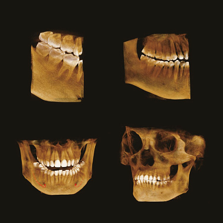 GENORAY Papaya 3D Plus 16x8 - компьютерный томограф с цефалостатом