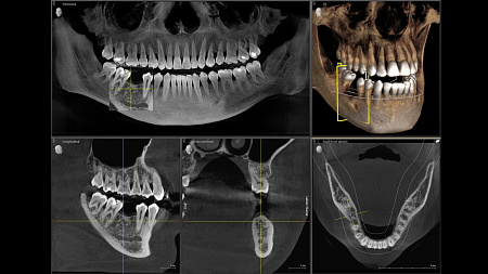 Sirona Orthophos SL 3D (11x10) – Дентальный томограф